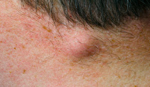 lump neck near hairline lumps swelling cancer skin hard side left right under spine ignore soft don hurts causes symptoms